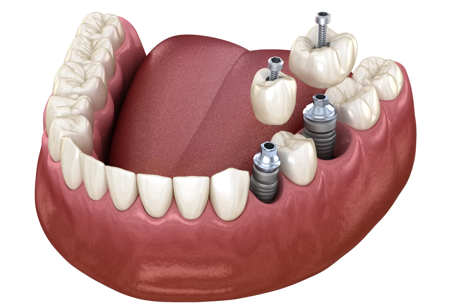 Одноетапна імплантація зубів