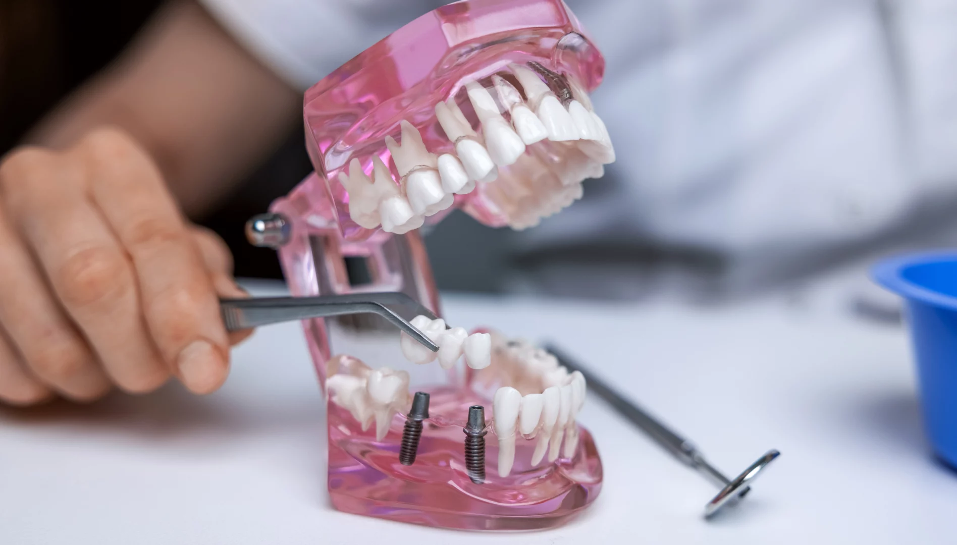 Что спросить у стоматолога перед имплантацией