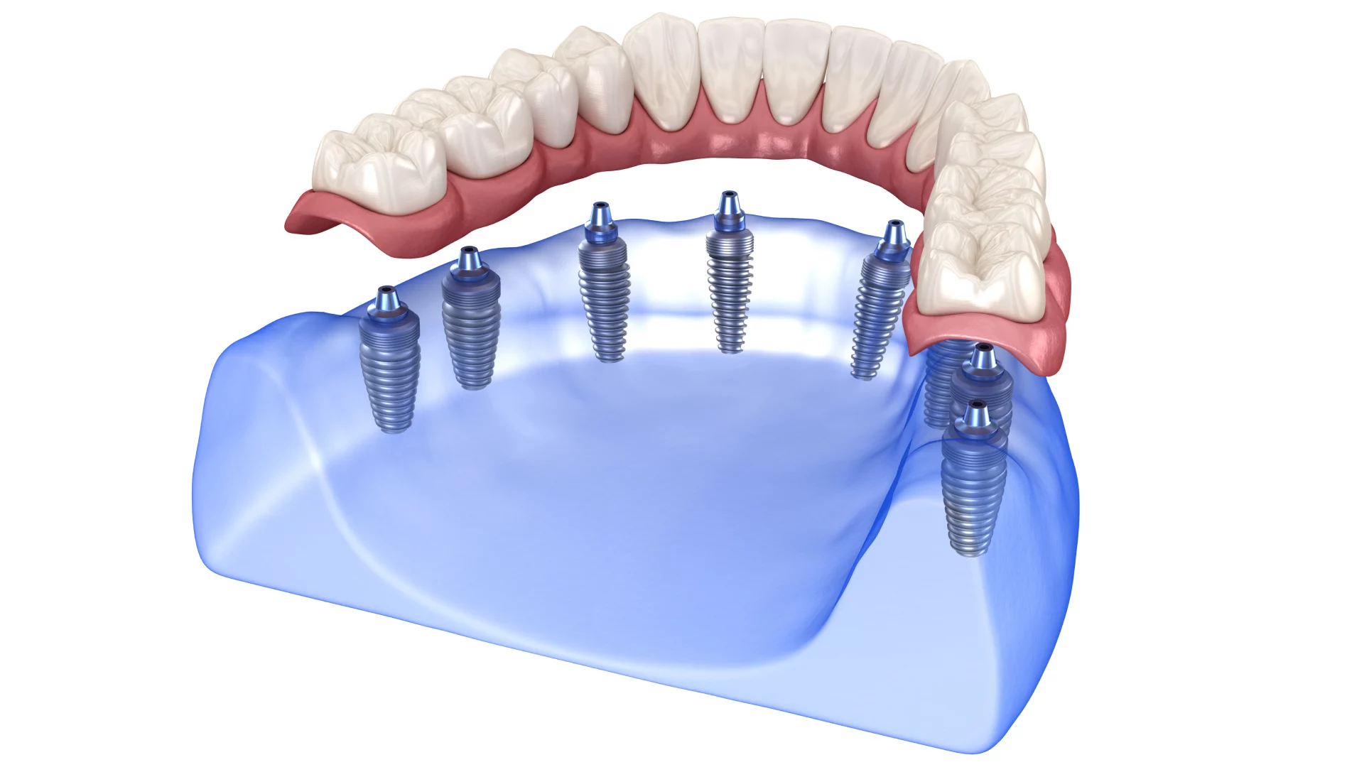 Протези зубів