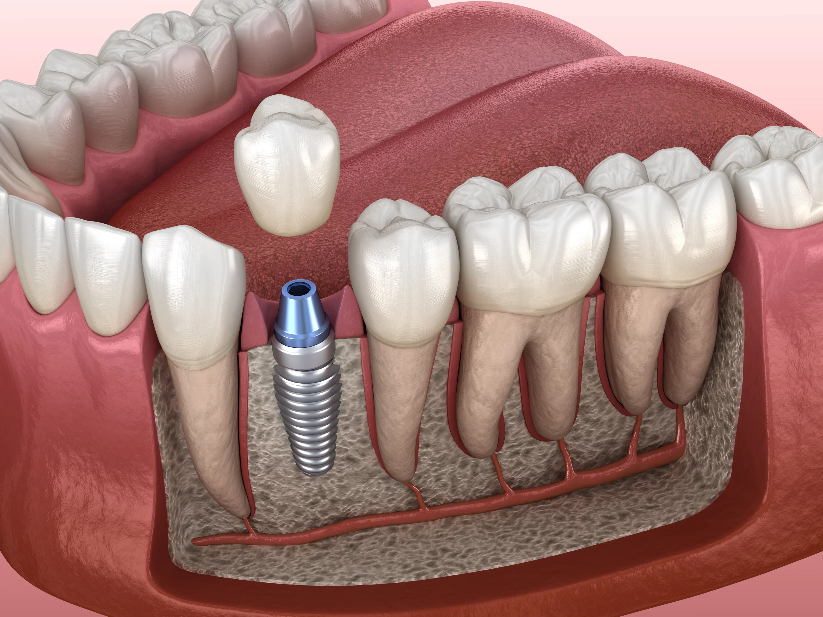 Двоетапна імплантація зубів