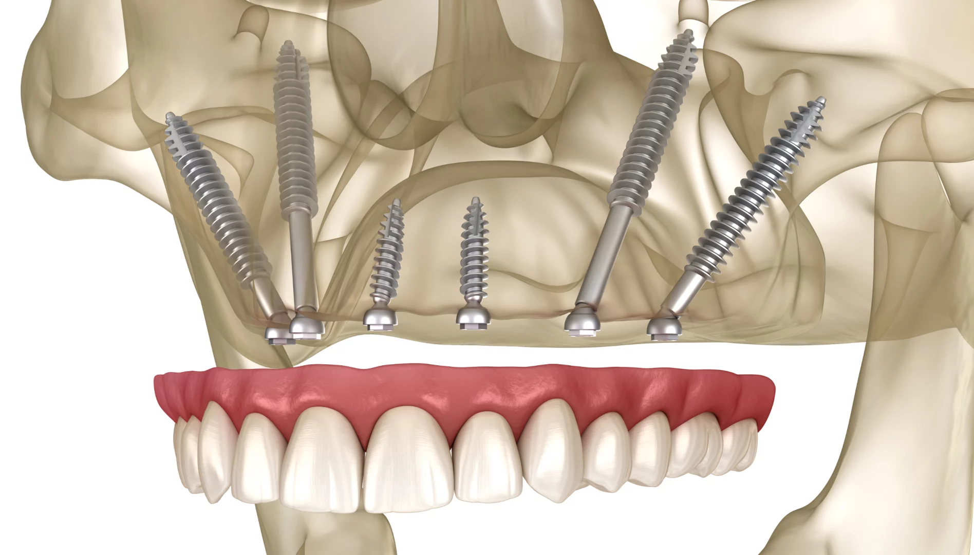 Базальна імплантація зубів