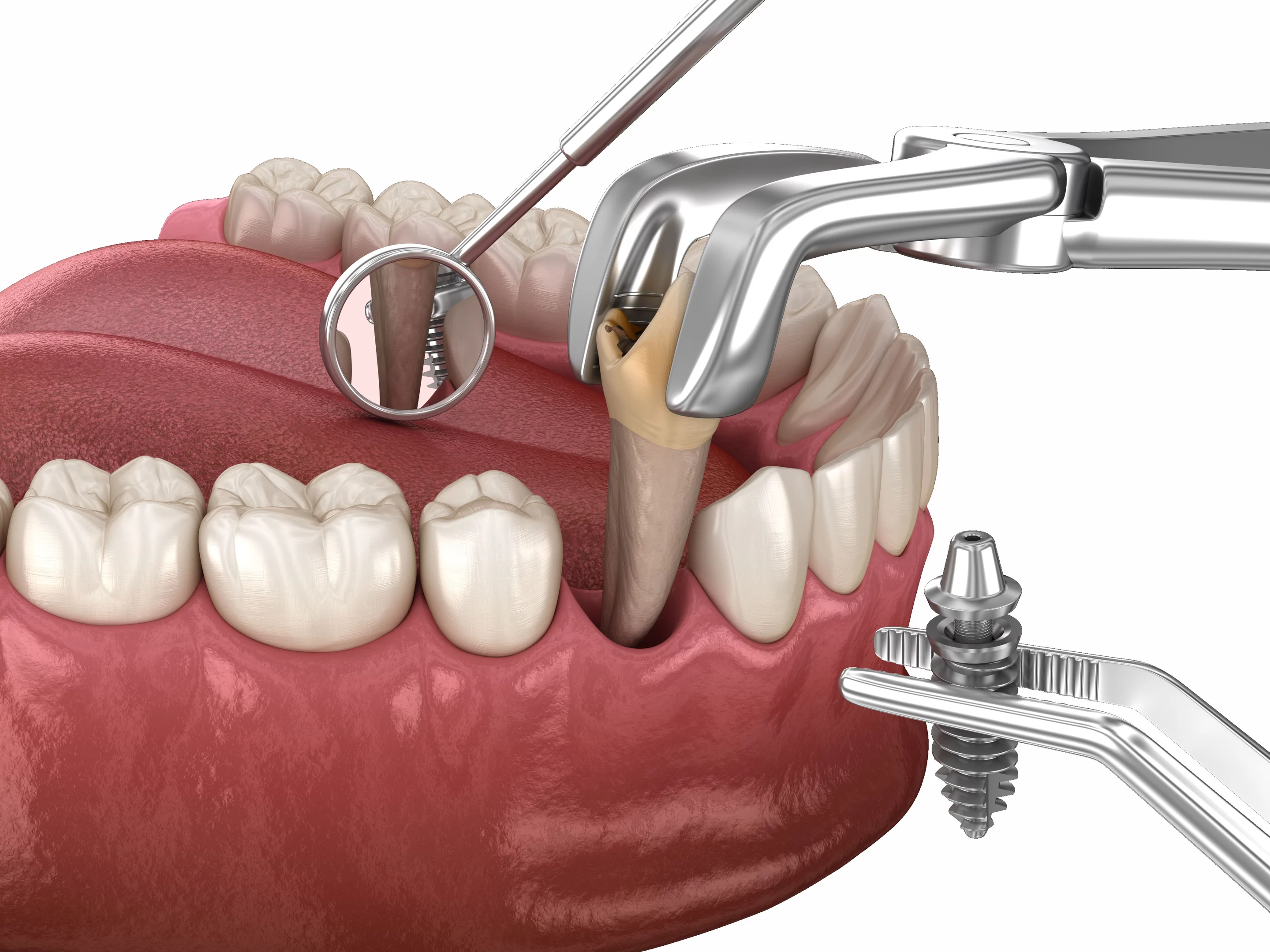 Одномоментна імплантація зубів