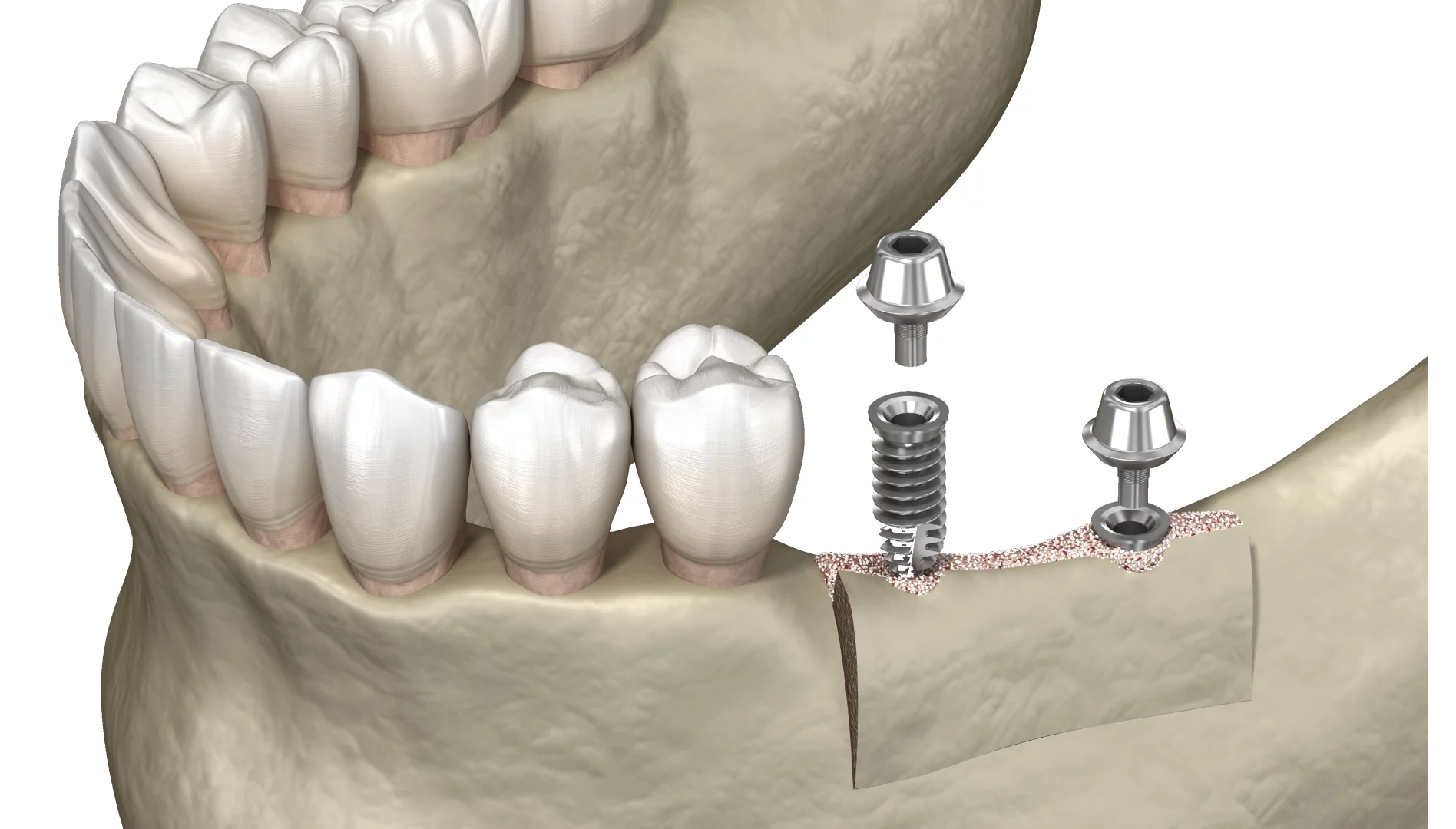 Що не можна робити після імплантації зубів