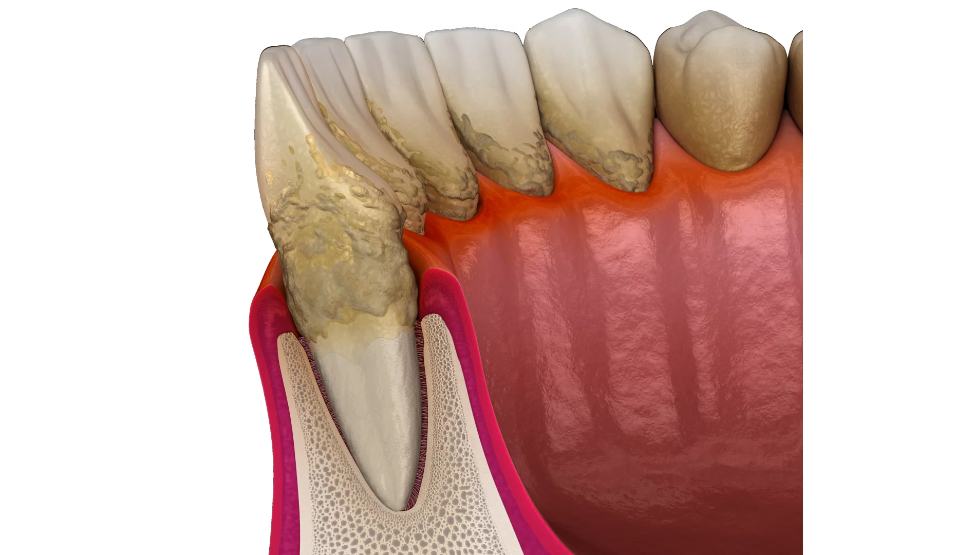 Імплантація зубів при пародонтиті та пародонтозі