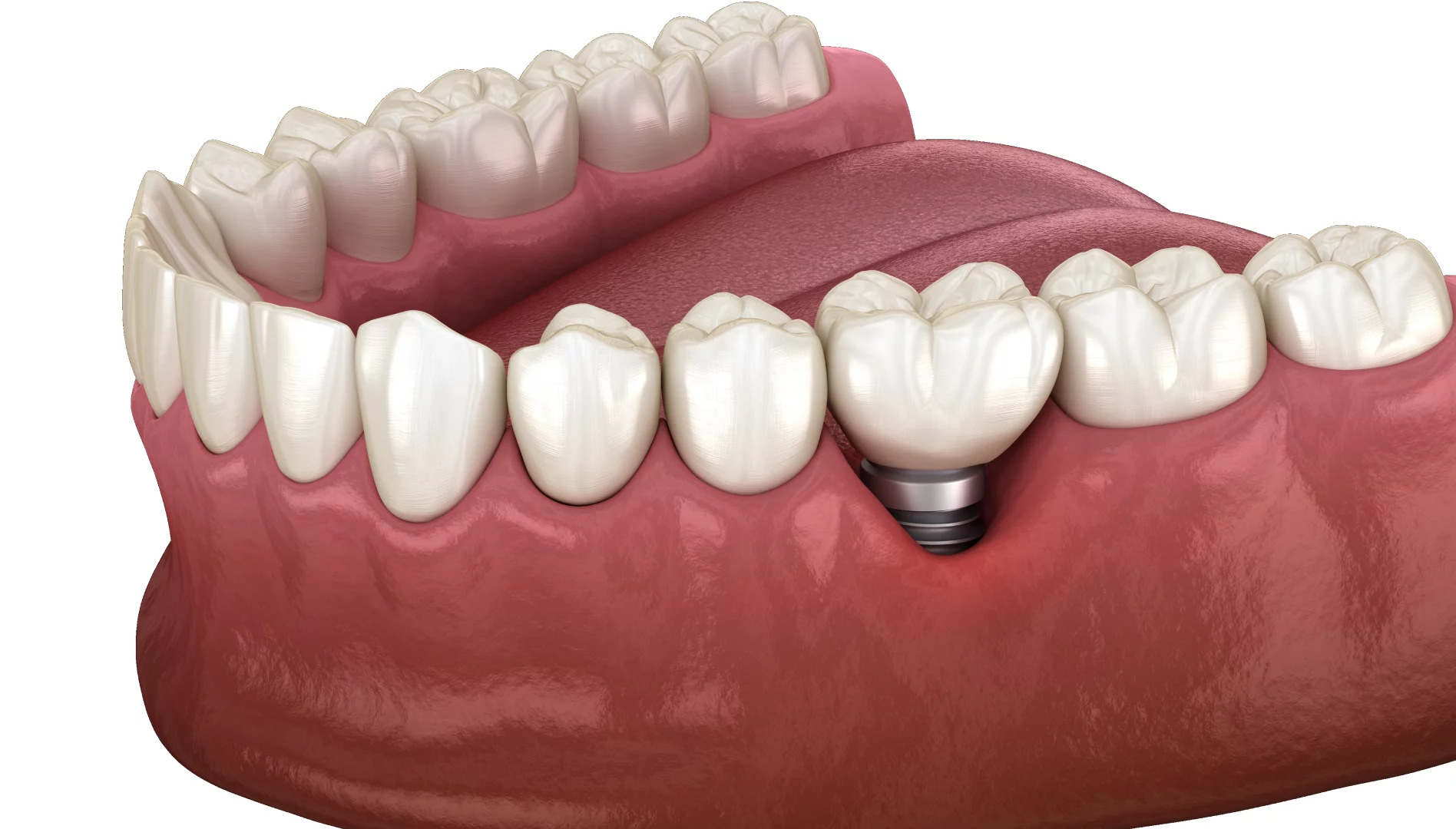 Відторгнення зубного імпланту