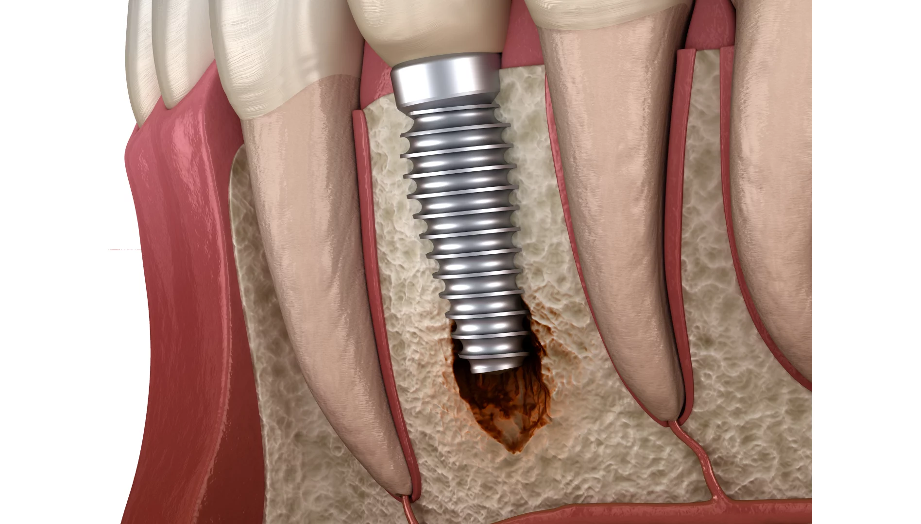 Відторгнення зубного імпланту