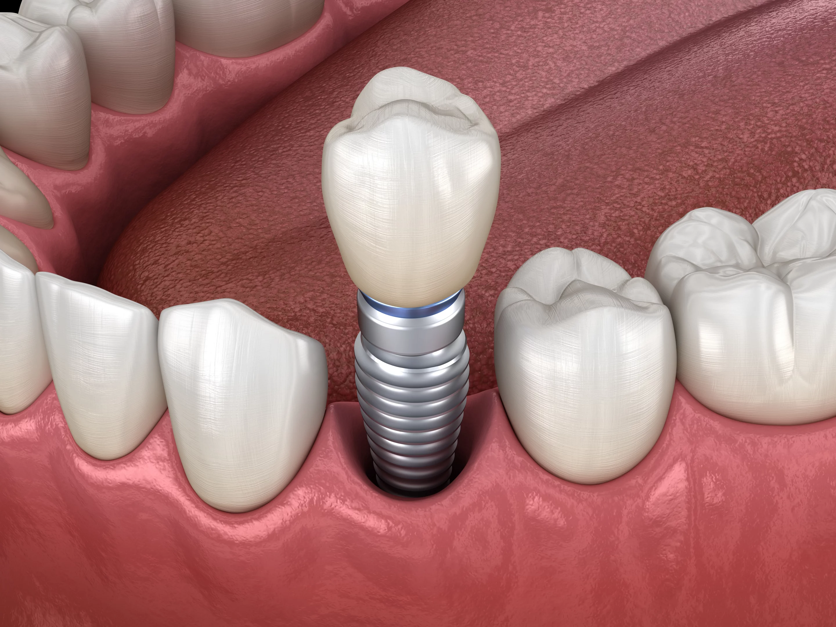 Імплант зубів