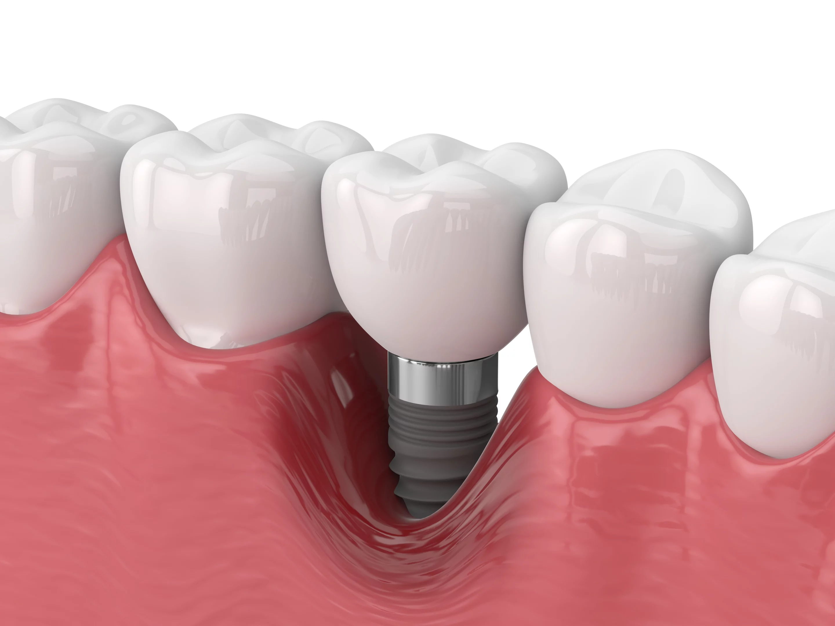 Відторгнення зубних імплантів