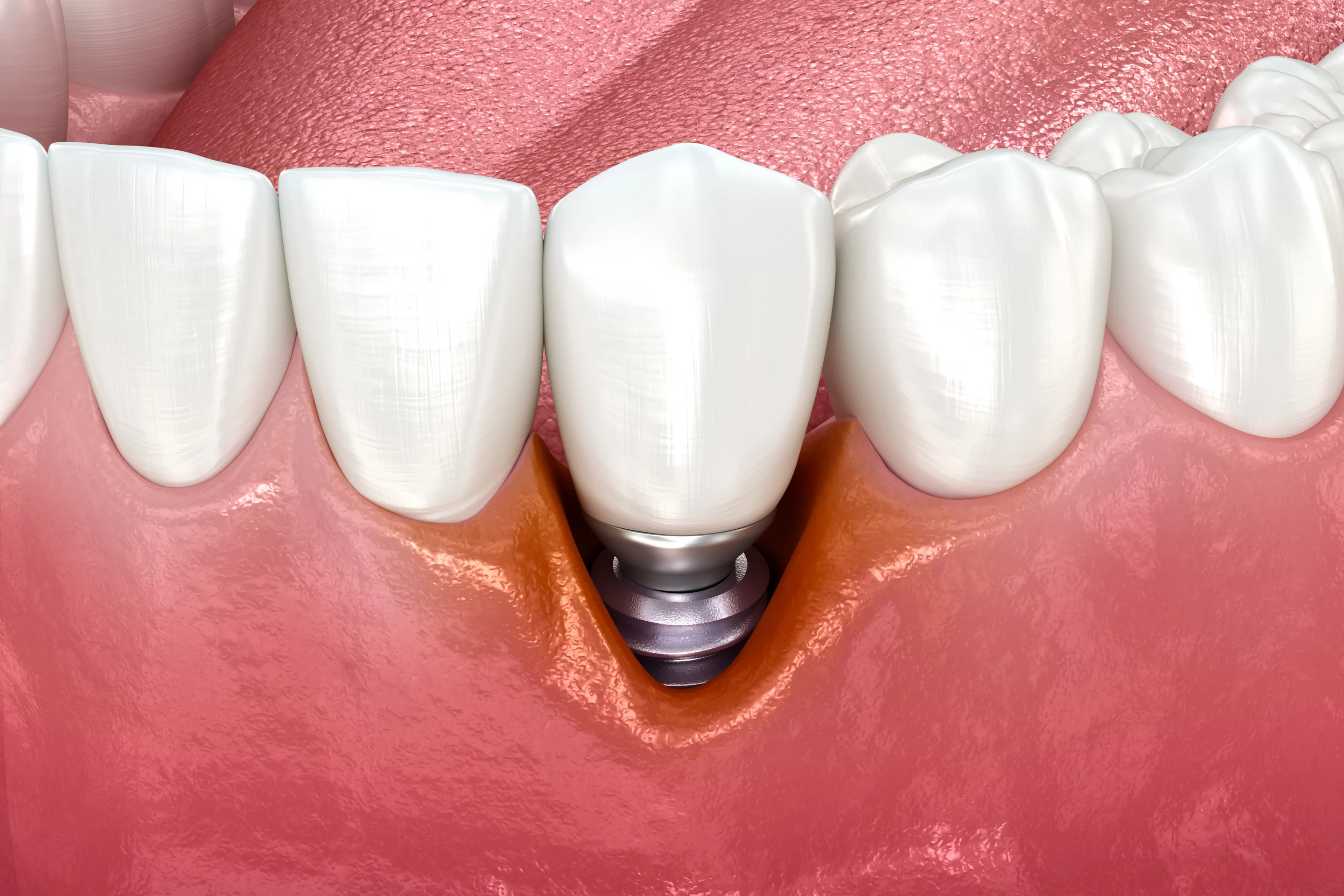 Відторгнення зубних імплантів