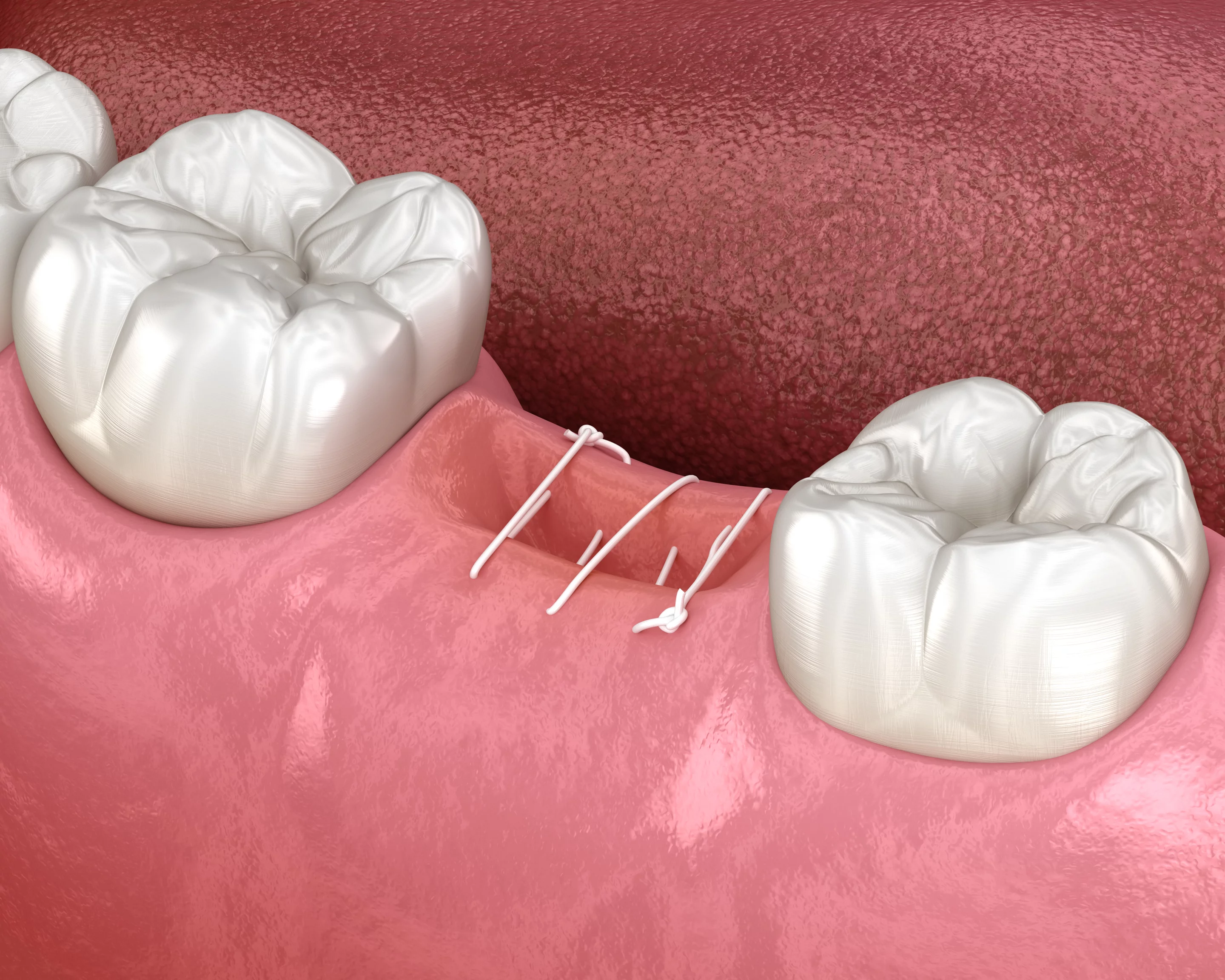 Догляд після видалення зуба