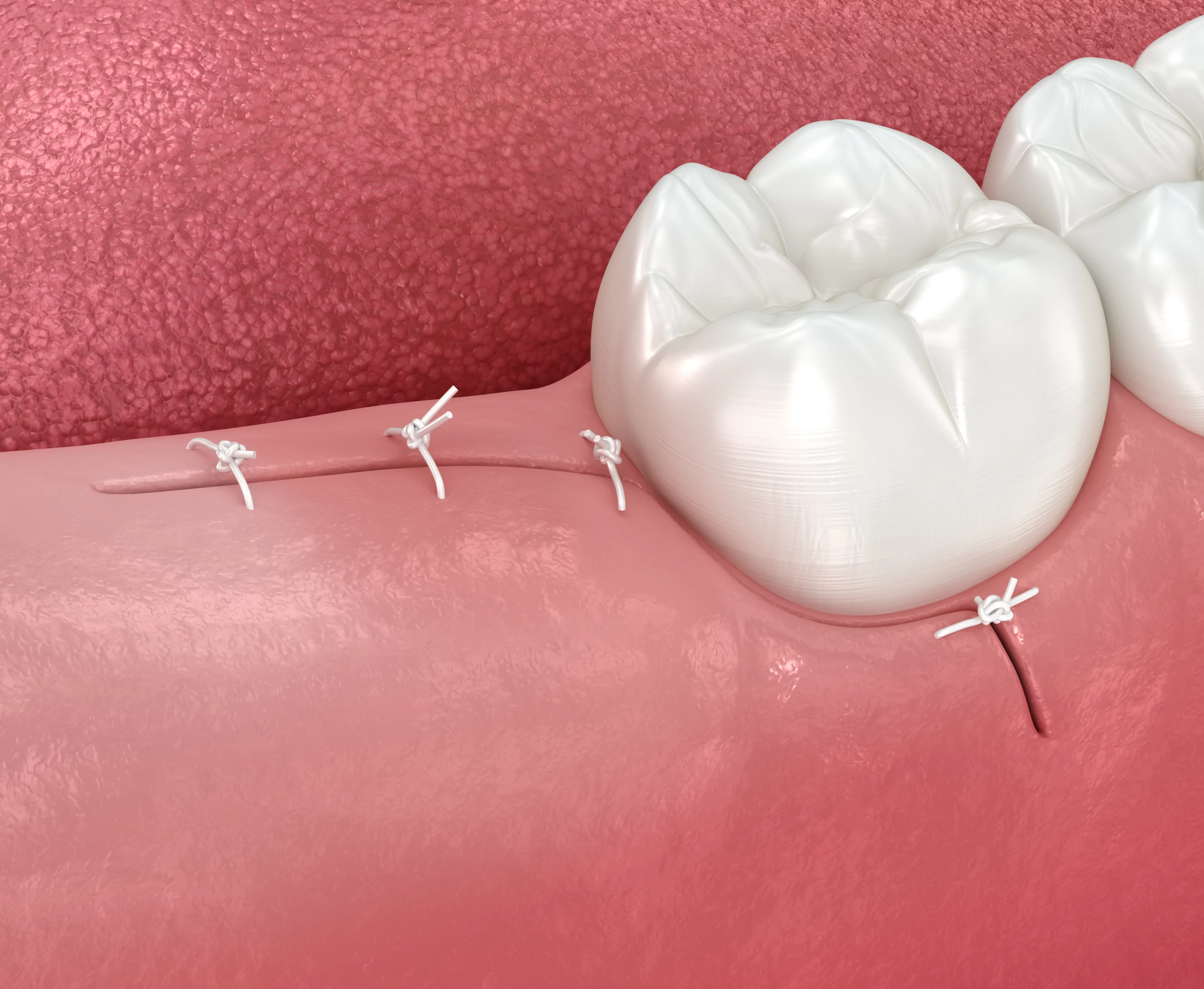 Догляд після видалення зуба
