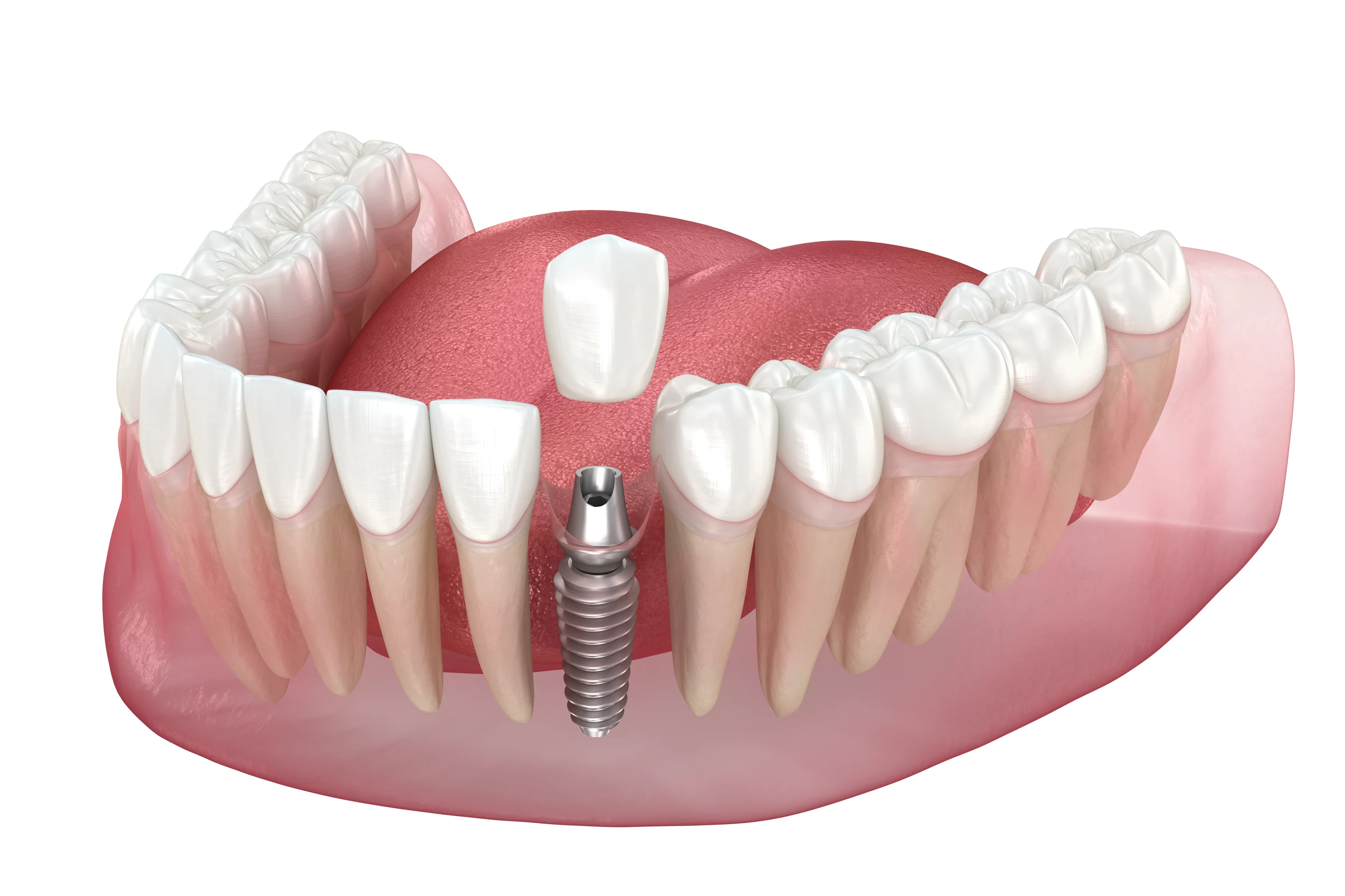 Імплант зубів