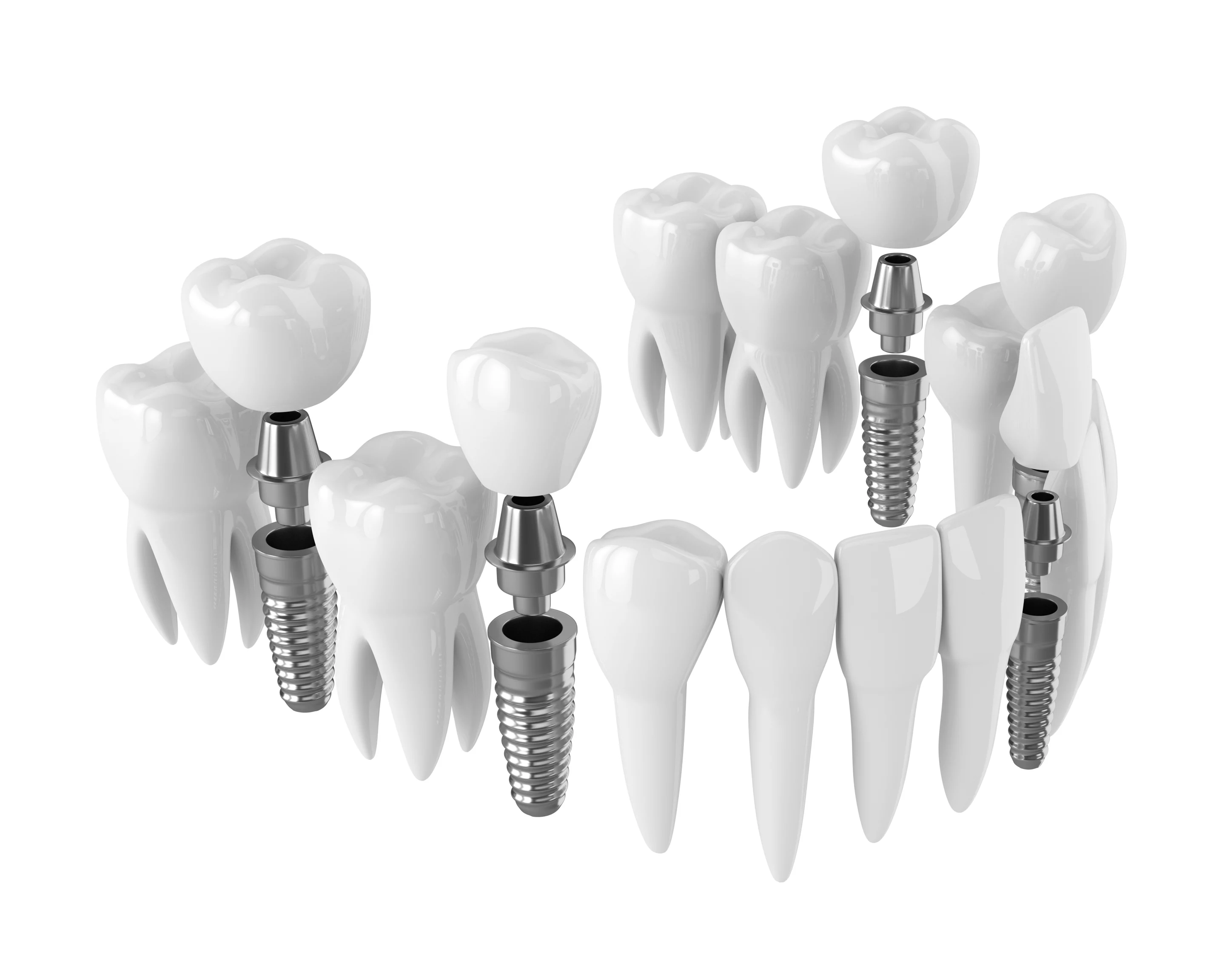 Протипоказання до імплантації зубів